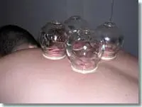 Cupping kan toegepast worden om iemands natuurlijk herstel vermogen te optimaliseren