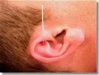 Ik pas tevens auriculotherapie of ooracupunctuur toe. Op het oor liggen ongeveer honderd punten die elk invloed uitoefenen op een bepaald orgaan of lichaamsdeel.